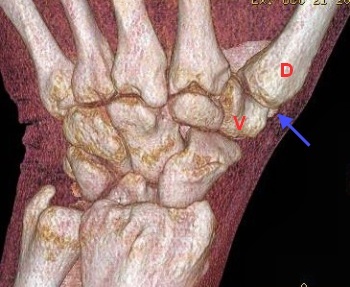 CT einer Handwurzel